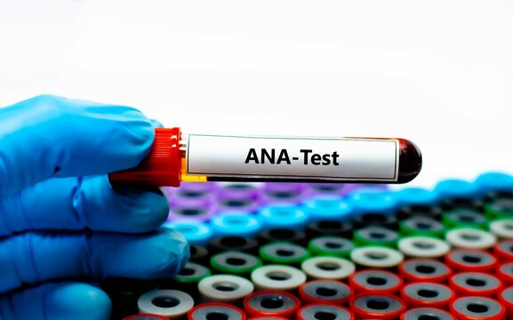 Blood sample tube for anti-nuclear antibody (ANA) test analysis.