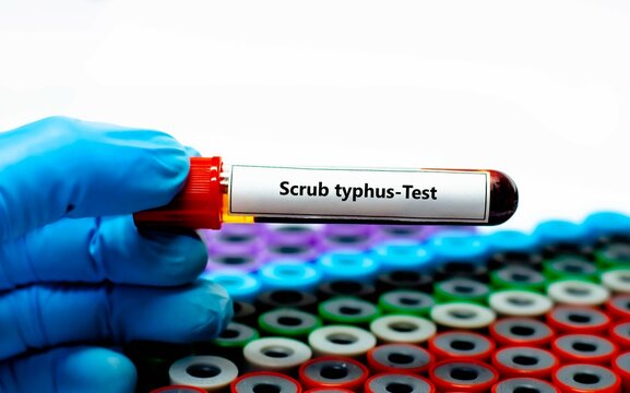 Blood sample tube for scrub typhus test analysis.