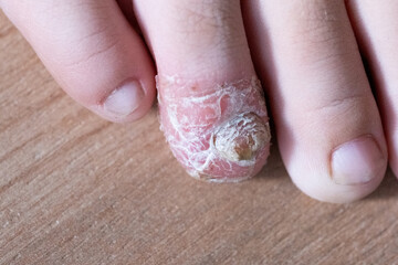 Fungus on child toe. Skin diseases. © freeman83