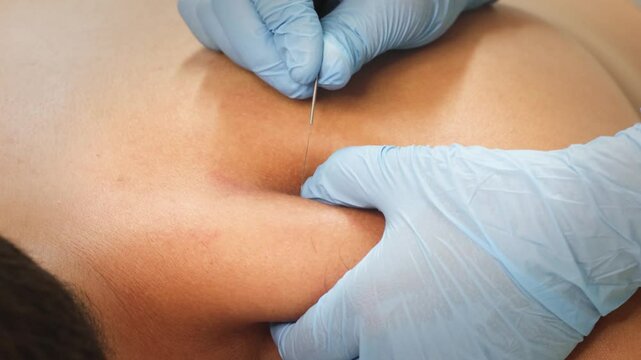 Physiotherapy Clinic: Dry Needling