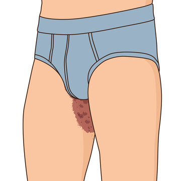 Tinea cruris on man's inguinal, illustration on white background