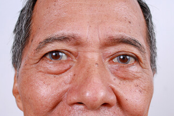 Close Up Of An Elderly Asian Man With Black Eye