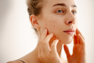 A woman touches her face gently while inspecting her skin for acne and imperfections. Pimples. Acne...