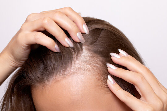 Young woman showing bald spots on forehead and temples with fingers. Baldness. Close-up. Hair care concept and treatment. Hair loss, hair transplant, alopecia