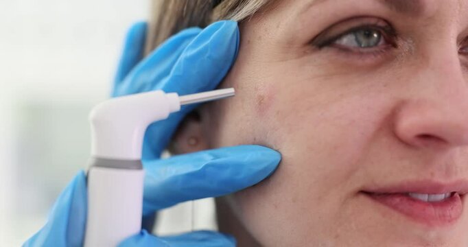Dermatologist uses laser to remove pimple from patient face. Doctor targets blemish to ensure removal and minimize damage to surrounding skin