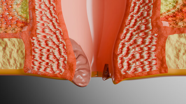 internal and external hemorrhoids piles, Human Anatomy Cross section, fistula, fissure, Virus infection in anal canal or lower rectum, treatment and prevention concept, external thrombosis, 3d render 
