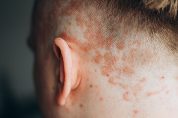Fototapeta premium Psoriasis on the skin close-up, scalp, photos of dermatitis and eczema, skin problems concept, dermatology banner