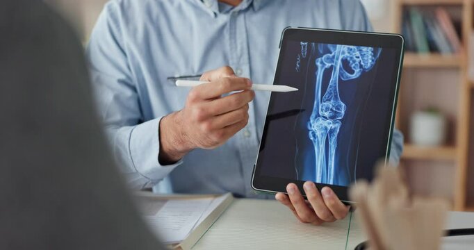 Osteoporosis, doctor and xray with tablet screen and hands for medical, report or treatment. Consultant, medicine or synthetic stem cell therapy with people and bone marrow transplant breakthrough