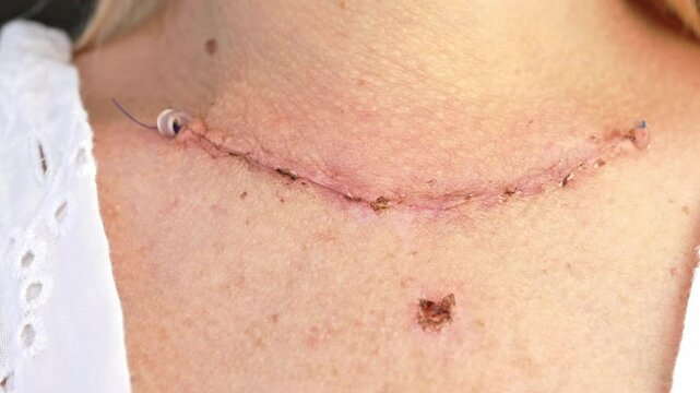 Scar on the neck from surgery. Thyroidectomy.