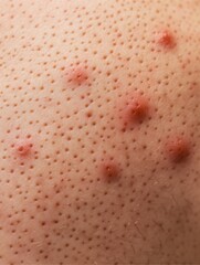 Fototapeta premium Skin Conditions: Bacterial and Viral Infections in Detail