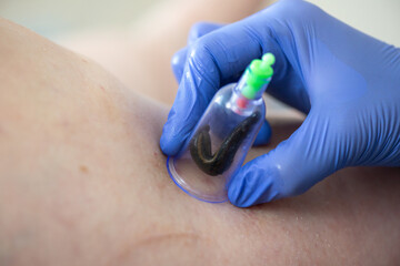 Hirudotherapy procedure. Doctor applying leech to patient's body. Close-up of doctors hand with...