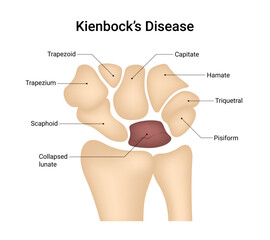 Causes of the Kienbock's Disease