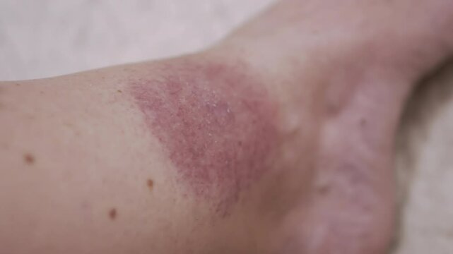 Close up, Formation of a Large Red Spot on the Skin from a Tick Bite. Irritation, itching, swelling, infection, redness around skin of leg. Lyme disease. Insect, mosquito, encephalitis tick bite.