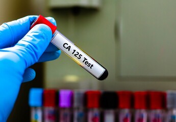 Blood sample tube for CA-125 test analysis.