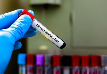 Fototapeta premium Blood sample tube for direct bilirubin test analysis.