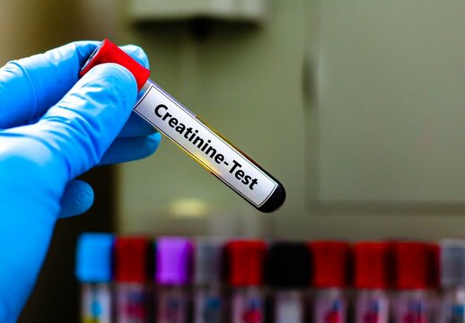 Blood sample tube for creatinine test analysis.