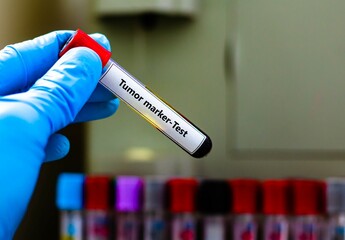 Blood sample tube for tumor marker test analysis.