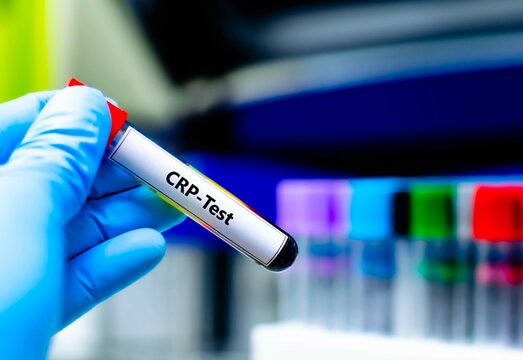 Blood sample tube for C-reactive protein (CRP) test analysis.