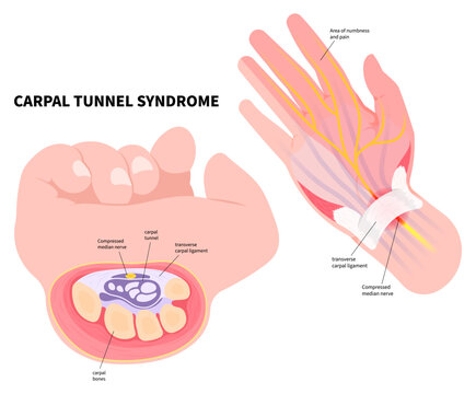 Wrist pain symptom of the Quervain's tenosynovitis disease and Carpal tunnel syndrome