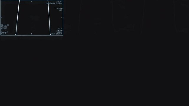 Magnetic resonance monochrome images of the brain, top view, MRI of the brain, of a patient with multiple vascular infarctions, 3x3 image grid, color animation Seamless Loop