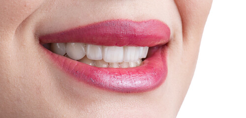 ceramic veneers b1 color