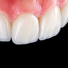 ceramic veneers b1 color