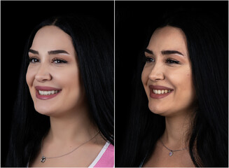 before and after picture of dental treatment by ceramic veneers