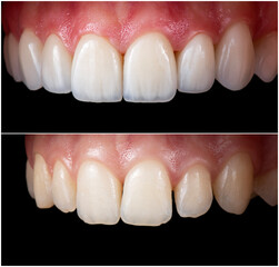 before and after picture of dental treatment by ceramic veneers
