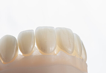 ceramic veneers b1 color