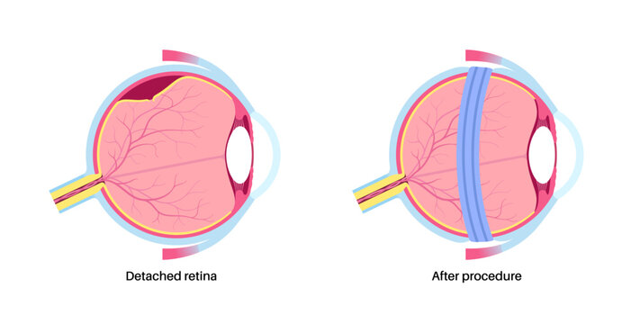 Scleral buckle procedure