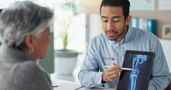 Consulting, doctor and documents with person for medical, osteoporosis or treatment plan. Healthcare, medicine and synthetic stem cell therapy with mature patient and bone marrow transplant trial