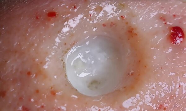 Subdermal Anomaly: A Close-Up of a Mysterious Skin Condition, 4K Video Stock.