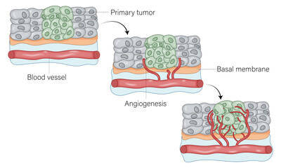 How Cancer Cells Create New Blood Vessels: The Angiogenic Process