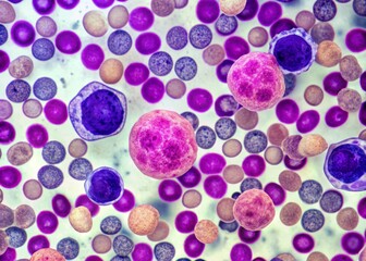 "Magnified bone marrow biopsy showing plasma cells with irregular nuclei and multiple myeloma tumor cells infiltrating normal hematopoietic tissue"