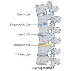 Detailed Anatomy of Spinal Disk Degeneration: Comprehensive Labeling of Intervertebral Disk Changes, Stages of Degeneration, and Impact on Spinal Structure