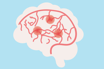 A transient ischemic attack (TIA) is a brief interruption of blood flow to the brain, causing stroke-like symptoms.  Related diseases: stroke, atherosclerosis, hypertension.pain