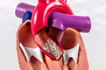 Cardiac model of Transcatheter aortic valve implantation (TAVI) for people education. Heart...