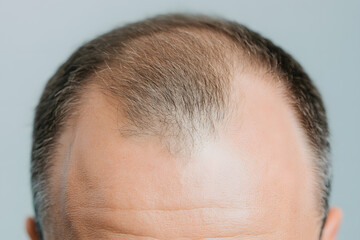 Obraz premium Man with a Head of Hair in a Hair Transplant Procedure | Effective Hair Restoration and Cosmetic Treatment