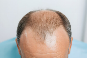 Obraz premium Man with a Head of Hair in a Hair Transplant Procedure | Effective Hair Restoration and Cosmetic Treatment