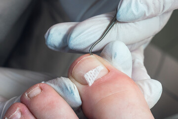 Medical pedicure, podiatrist doing tamponade to a deformed toenail