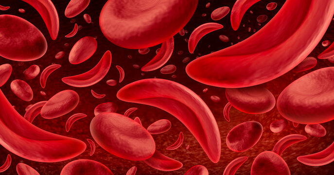 Sickle cell anemia as a red blood disease as a normal and abnormal hemoglobin anatomy medical illustration concept