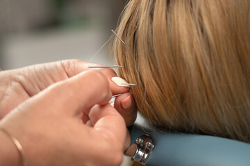 Acupuncture Therapist applying needles into the scalp surface to regenerate brain system