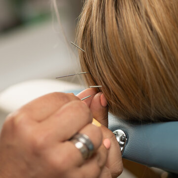 Acupunturist applying needles into the loose areolar tissue layer of the scalp to stimulate meridian points