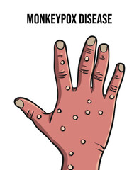 Illustration of a hand vector affected by monkeypox virus disease. Illustration of hand bumps