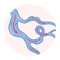 Varicose veins. Blue blood vessel visible through the skin. Vascular disease diagnostic and treatment. Venous insufficiency medical
