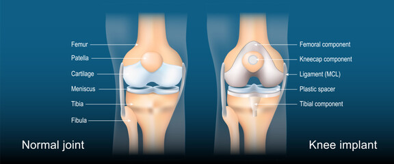 Total knee arthroplasty. Knee joint replacement