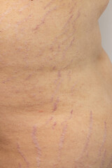 Fototapeta premium A woman's back has a scar that is purple and red