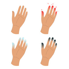 Obraz premium Frostbite stages infographic vector isolated. Damaged fingers. Signs of hypothermia. Concept of health care, symptoms of frostbite.