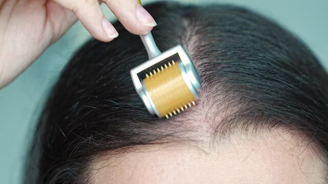 Close up view of young woman using microneedle derma roller on head for stimulating new hair growth in home. Treatment for the healthy scalp.