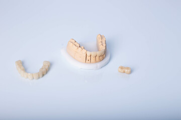 Glass ceramic dental porcelain veneers and crowns used in smile design treatment in dental dentistry. © Nastasia